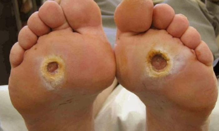Diabetic Foot Ulcers (DFUs)