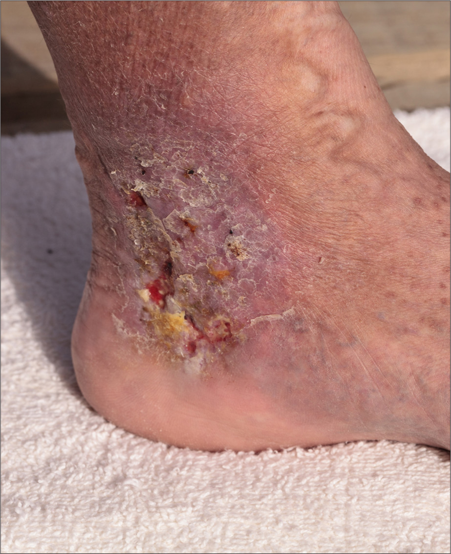 Lymphedema-Related Skin Breakdown