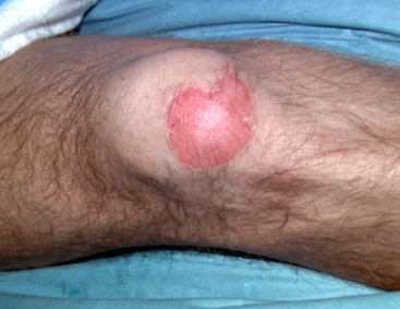 Partial-Thickness and Burns